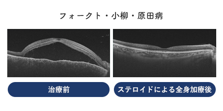 フォークト・小柳・原田病の治療前とステロイドによる全身加療後の比較画像