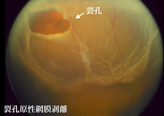 裂孔原性網膜剥離の画像