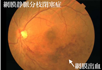 網膜静脈分枝閉塞症　眼球の網膜出血が起きている場所を指している