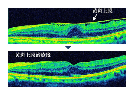 上：黄斑上膜の場所を指している画像　下：黄斑上膜治療後の画像