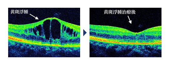 左：黄斑浮腫を指す画像　右：黄斑浮腫治療後の画像