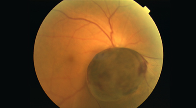 脈絡膜悪性黒色腫の眼球