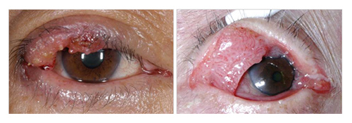 （左）眼瞼脂線癌　（右）眼瞼結膜扁平上癌