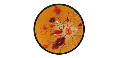 IY 14歳 白血病網膜症。本疾病に特徴的なRoth斑（出血の中の白斑）が描かれている