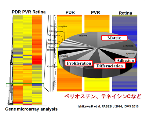 図2．眼内線維増殖組織の包括的遺伝子解析による病態責任分子の同定