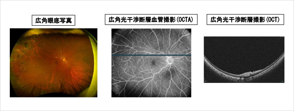 図5．早期眼内線増殖性変化を捉える画像解析システム開発