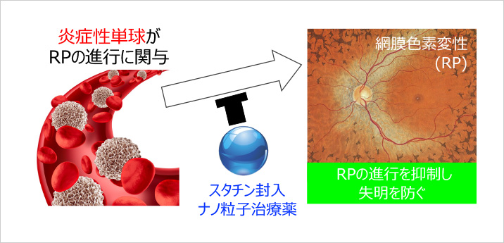 末梢血の炎症性単球をターゲットとした網膜色素変性に対する治療薬の開発