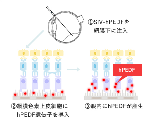 イメージ図1：1．SIV-hPEDFを網膜下に注入　2．網膜色素上皮細胞にhPEDF遺伝子を導入　3．眼内にhPEDFが産生