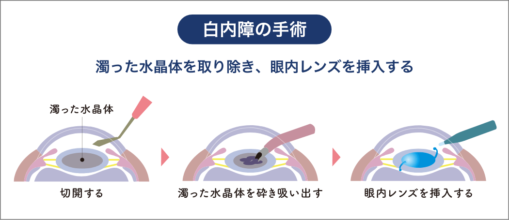 白内障の手術 濁った水晶体を取り除き、眼内レンズを挿入する