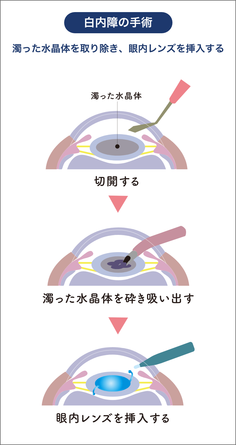 白内障の手術 濁った水晶体を取り除き、眼内レンズを挿入する