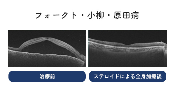 フォークト・小柳・原田病の治療前とステロイドによる全身加療後の比較画像