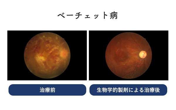ベーチェット病の治療前と生物学的製剤による治療後の比較画像