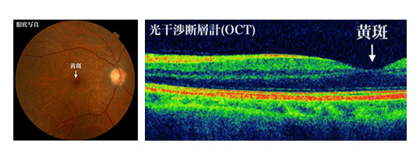黄斑の場所を説明する画像