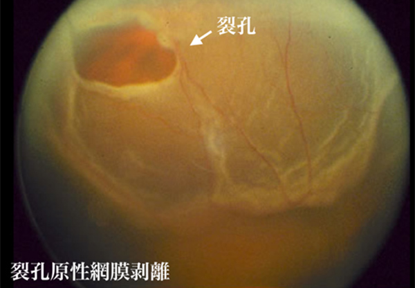 裂孔原性網膜剥離の画像