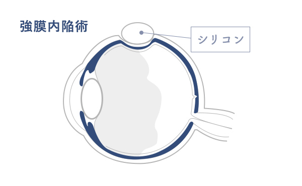 強膜内陥術 眼球内にシリコンを入れているイラスト