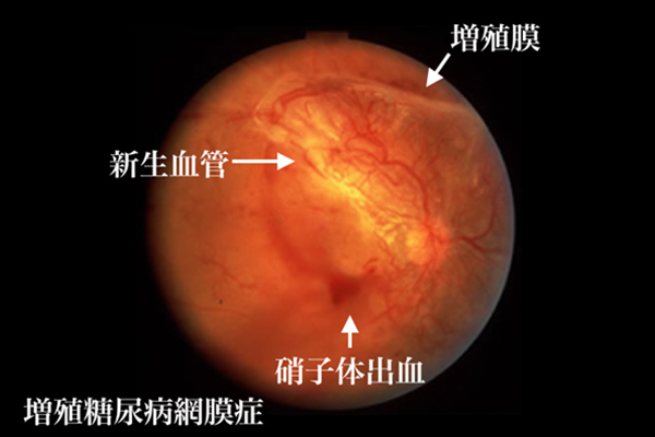 増殖糖尿病網膜症 眼球の新生血管、増殖膜、硝子体出血の場所を指している