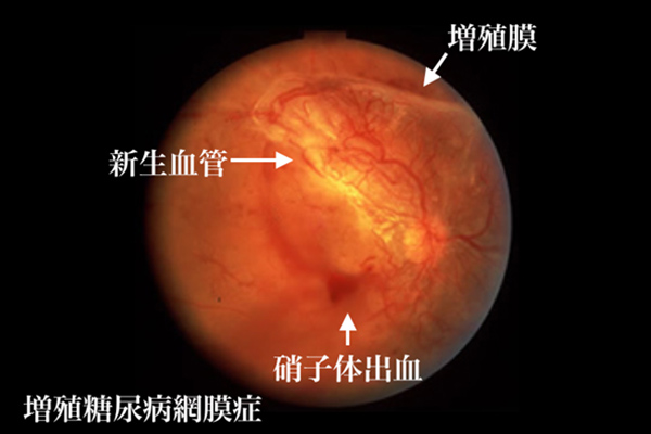 増殖糖尿病網膜症　眼球の新生血管、増殖膜、硝子体出血の場所を指している