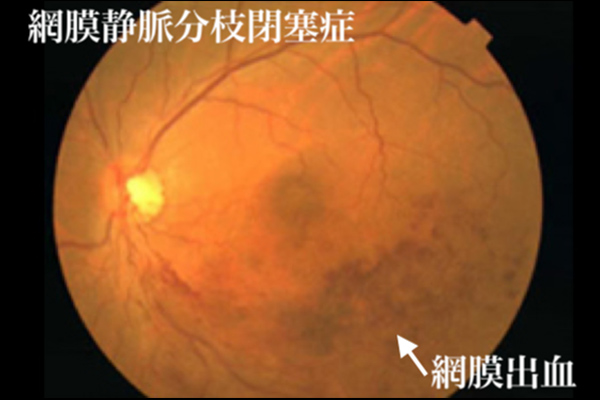 網膜静脈分枝閉塞症 眼球の網膜出血が起きている場所を指している