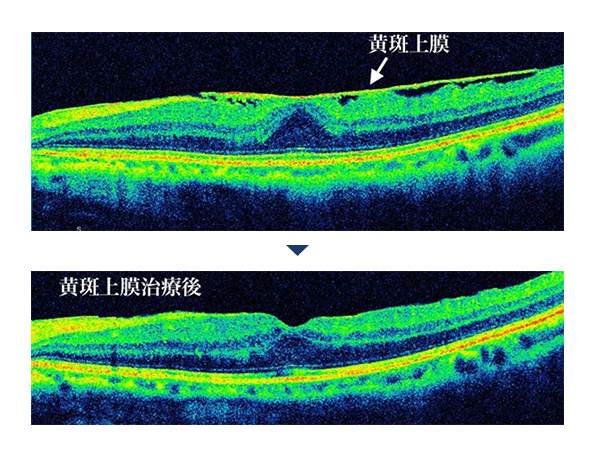 上：黄斑上膜の場所を指している画像　下：黄斑上膜治療後の画像