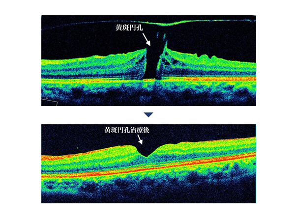 上：黄斑円孔の場所を指している　下：黄斑円孔治療後