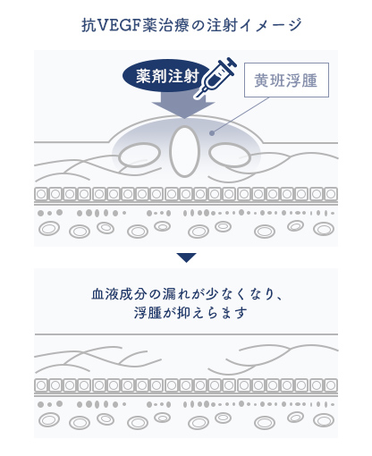 抗VEGF薬治療の注射イメージのイラスト 黄斑浮腫に薬剤注射をする→血液成分の漏れが少なくなり、浮腫が抑えられます