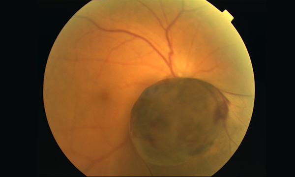 脈絡膜悪性黒色腫の眼球