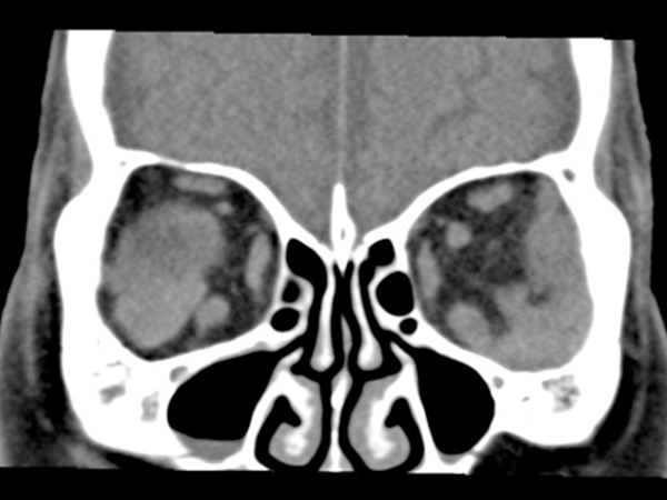 眼周囲のレントゲン画像