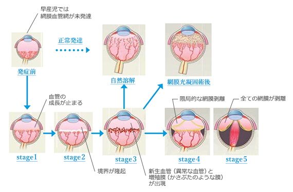 未熟児網膜症の治療　発症前（早産児では網脱血管網が未発達）→ステージ1（血管の成長がとまる）→ステージ2（境界が隆起）→ステージ3：新生血管（正常な血管）と増殖膜（かさぶたのような膜）が出現→ステージ4（眼局的な網膜剥離）→ステージ5：（全ての網膜が剥離）
