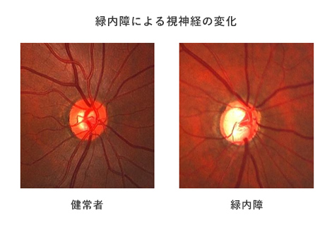 右目の眼底写真：緑内障による視神経の変化。健常者の目と緑内障の比較画像