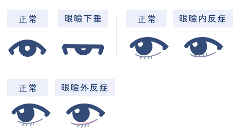 正常な目と眼瞼下垂の目の比較イラスト、正常な目と眼瞼内反症の目の比較イラスト、正常な目と眼瞼外反症の比較イラスト