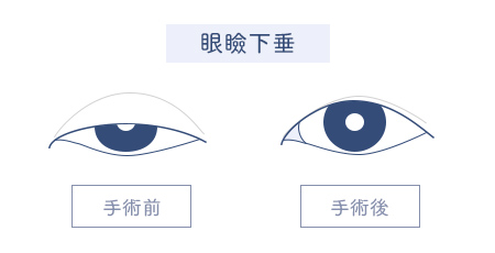 眼瞼下垂の手術前と手術後の目のイラスト