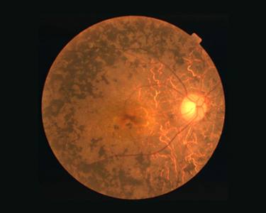 網膜色素変性患者の眼底写真