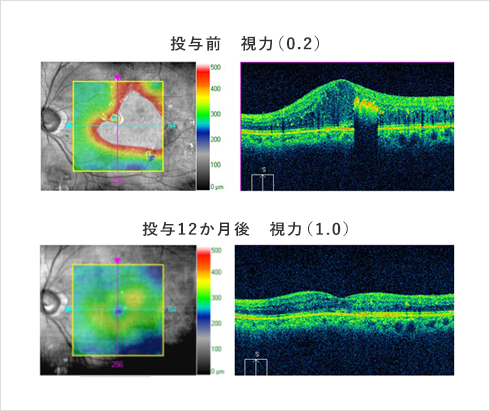 糖尿病黄斑浮腫への抗VEGF薬治療　上：投与前　視力0.2　下：投与12ヶ月後　視力1.0