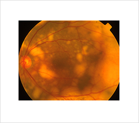 眼内悪性リンパ腫患者の眼底写真