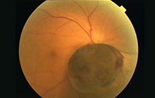 脈絡膜悪性黒色腫の眼球