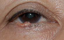 目の下に腫瘍ができている女性の目